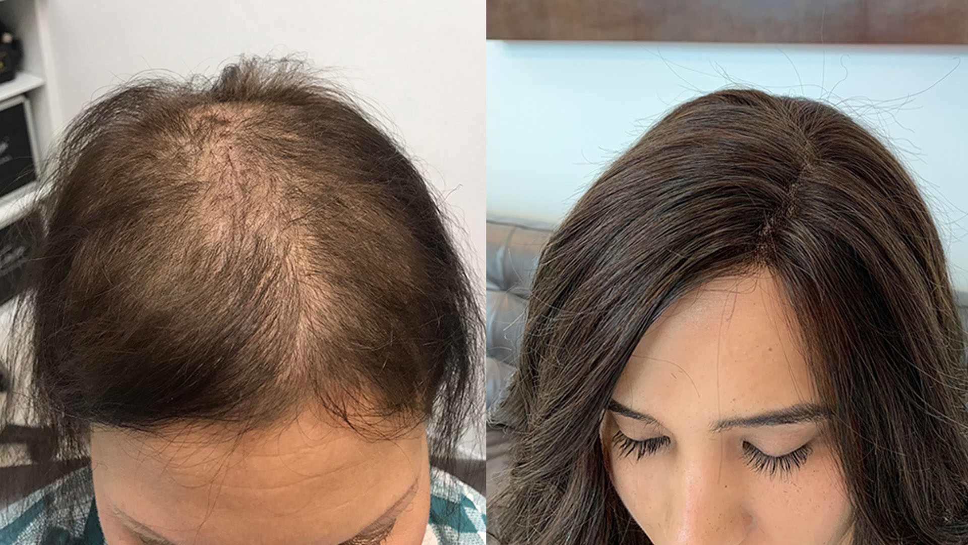 Three Stage Cancer Hair Loss Process | Chuck Alfieri