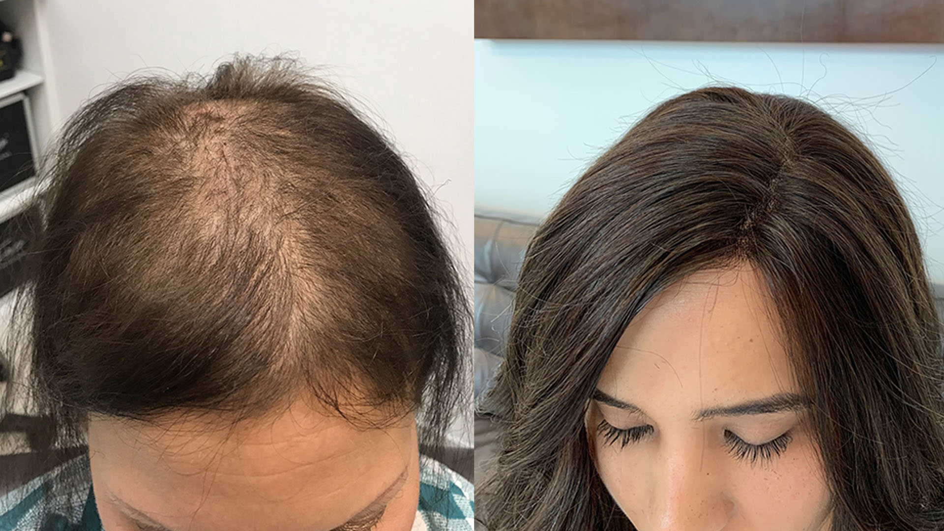 three-stage-cancer-hair-loss-process-chuck-alfieri