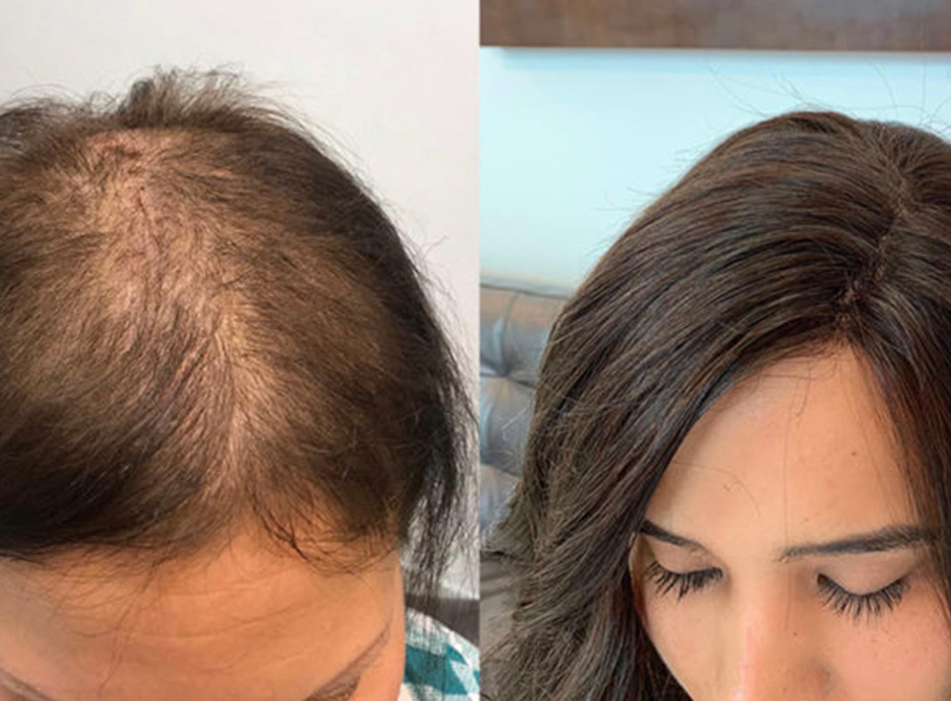 Cancer Hair Loss