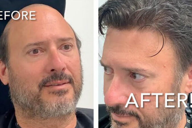 Split-screen comparison of a man: left shows balding crown before, right shows fuller hair after treatment; 'BEFORE' and 'AFTER' text visible