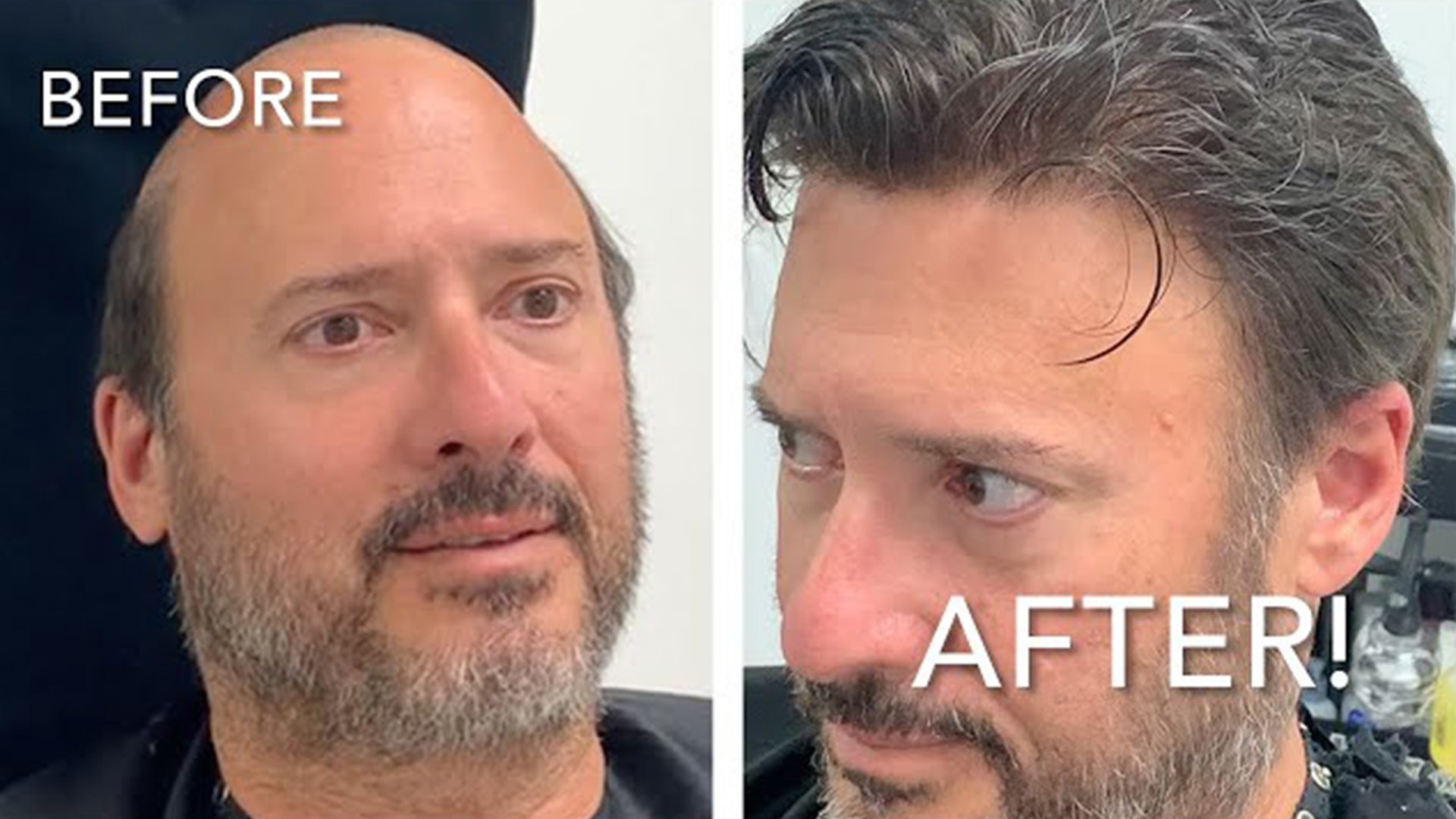 Split-screen comparison of a man: left shows balding crown before, right shows fuller hair after treatment; 'BEFORE' and 'AFTER' text visible